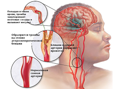 Последствия инсульта