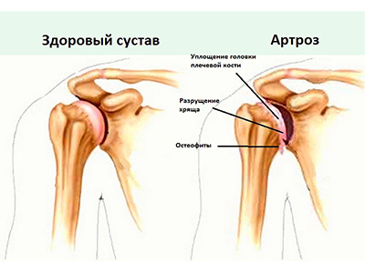 Артроз плечевых суставов