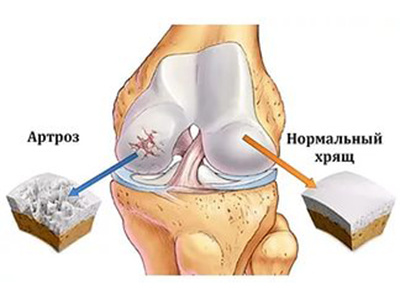Артроз коленных суставов