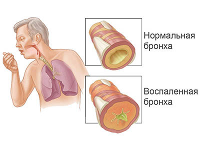 Бронхит