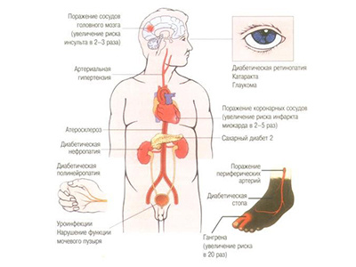 Сахарный диабет