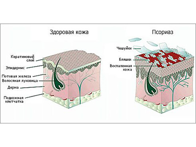 Псориаз