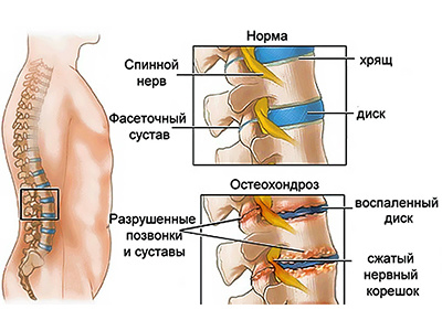 Остеохондроз поясничного отдела позвоночника